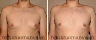 Before and After Treatment Photos: gynecomastia surgery - 24 year old patient