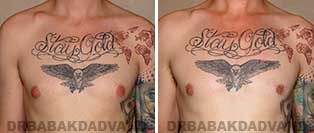 Before and After Treatment Photos: gynecomastia surgery-28 year old patient