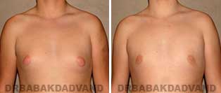 Before and After Treatment Photos: gynecomastia surgery-15 year old patient