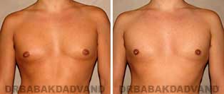 Before and After Treatment Photos: gynecomastia surgery- 29 year old patient