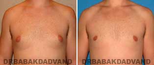 Before and After Treatment Photos: Gynecomastia Surgery: 27 year old, patient