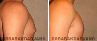 Before and After Treatment Photos.Gynecomastia Surgery - 18 year old, patient