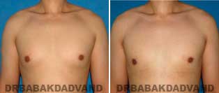 Before and After Treatment Photos.Gynecomastia Surgery - 24 year old, patient