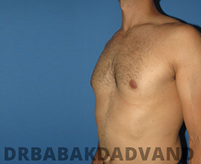 Before and After Treatment Photos: Puffy Nipples