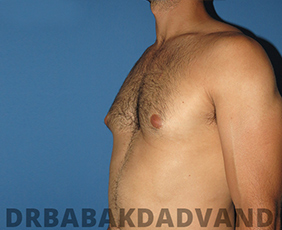 Before and After Treatment Photos: Puffy Nipples