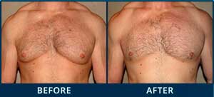 Man left so distressed by the growth of a single B-cup breast, he