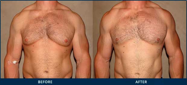 Gynecomastia and Steroid Use