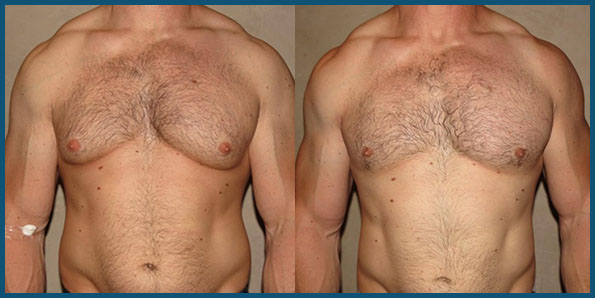 Gynecomastia in Bodybuilders Male Breast Reduction in LA