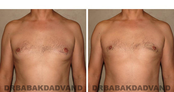 Gynecomastia. Before and After Treatment Photos - male, front view (patient 37)