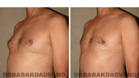 Gynecomastia. Before and After Treatment Photos - male, right side oblique view (patient 37)