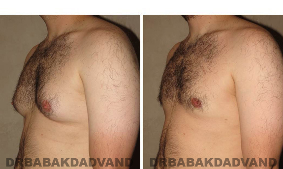 Gynecomastia. Before and After Treatment Photos - male, left side oblique view (patient 40)