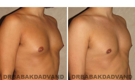 Gynecomastia. Before and After Treatment Photos - male, right side oblique view (patient 41)
