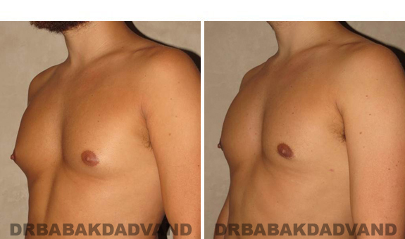 Gynecomastia. Before and After Treatment Photos - male, left side oblique view (patient 41)