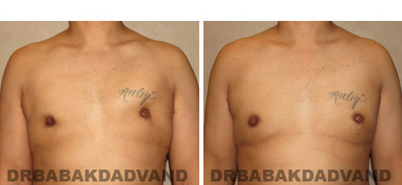 Gynecomastia. Before and After Treatment Photos - male, front view (patient 44)