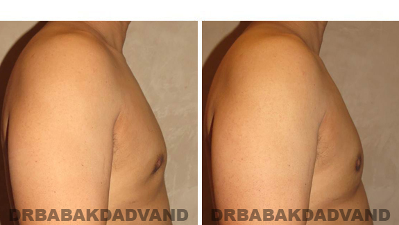 Gynecomastia. Before and After Treatment Photos - male, right side view (patient 44)