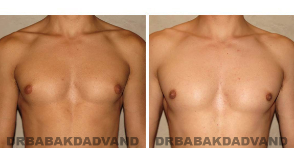 Gynecomastia. Before and After Treatment Photos - male, front view (patient 46)