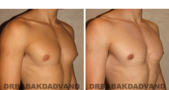Gynecomastia. Before and After Treatment Photos - male, right side oblique view (patient 46)