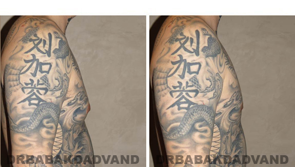 Gynecomastia. Before and After Treatment Photos  - male - right side view (patient 49)
