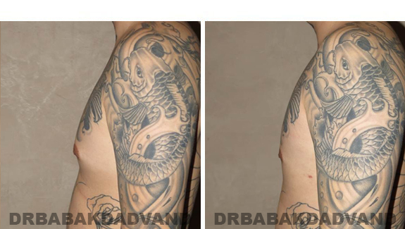 Gynecomastia. Before and After Treatment Photos  - male - left side view (patient 49)