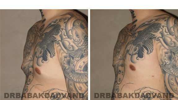 Gynecomastia. Before and After Treatment Photos  - male - left side oblique view (patient 49)