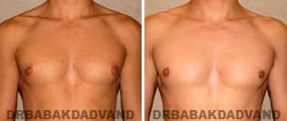 Before and After Treatment Photos: gynecomastia surgery- 20 year old patient