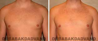 Before and After Treatment Photos: gynecomastia surgery- 36 year old patient