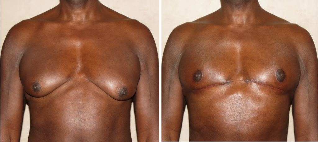 Before and After Photos: NIPPLE REPOSITIONING