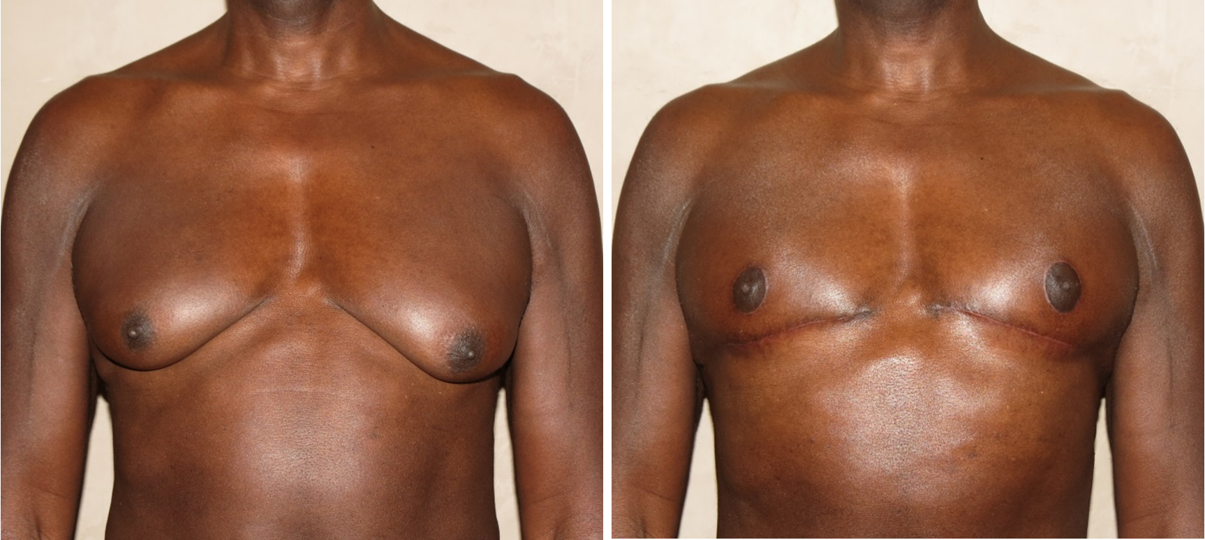 Nipple Repositioning & Skin Excision