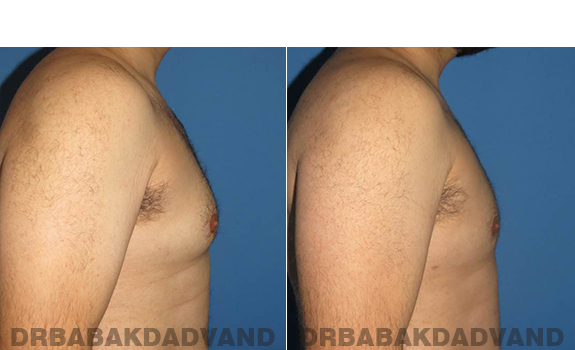 Gynecomastia. Before and After Treatment Photos - male - right side view (patient - 57)