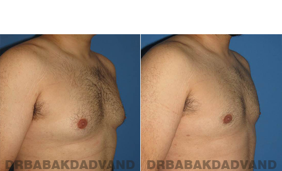 Gynecomastia. Before and After Treatment Photos - male - right side oblique view (patient - 57)