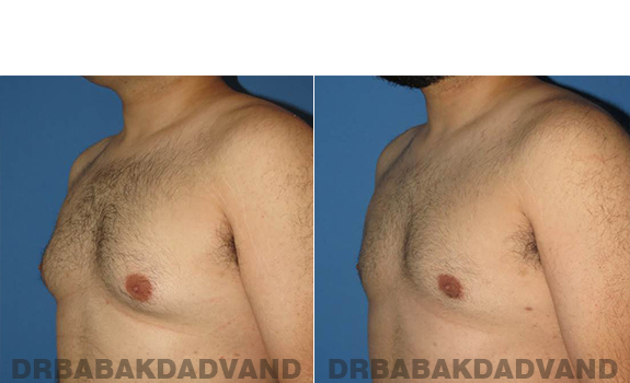 Gynecomastia. Before and After Treatment Photos - male - left side oblique view (patient 57)