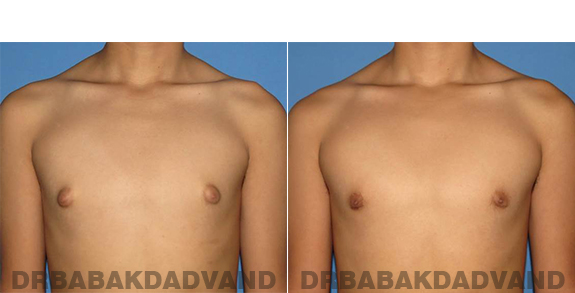 Gynecomastia. Before and After Treatment Photos - male - front view (patient - 60)
