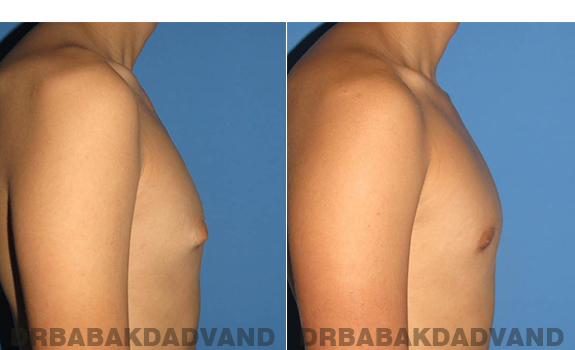 Gynecomastia. Before and After Treatment Photos - male - right side view (patient - 60)