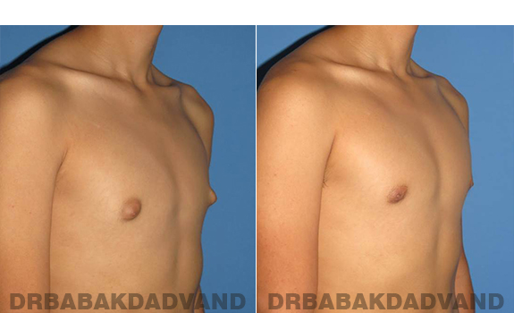 Gynecomastia. Before and After Treatment Photos - male - right side oblique view (patient - 60)