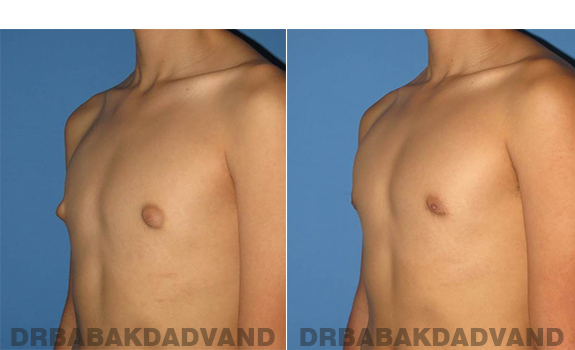 Gynecomastia. Before and After Treatment Photos - male - left side oblique view (patient 60)