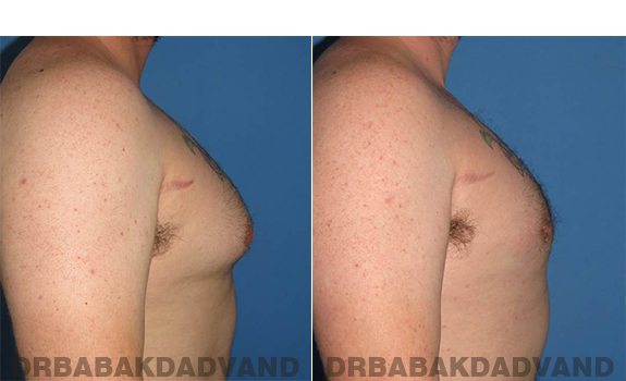 Gynecomastia. Before and After Treatment Photos - male - right side view (patient - 61)