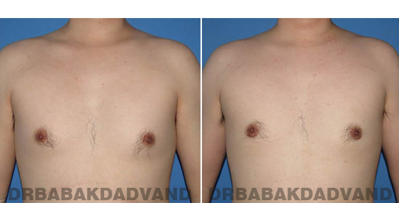 Gynecomastia. Before and After Treatment Photos - male - front view (patient - 64)