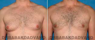 Before and After Treatment Photos.Gynecomastia Surgery - 34 year old, patient