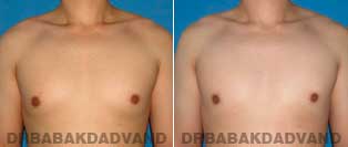 Before and After Treatment Photos - Gynecomastia Surgery - 24 year old, patient