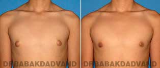 Before and After Treatment Photos - Gynecomastia Surgery - 16 year old, patient