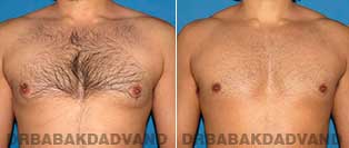 Before and After Treatment Photos - Gynecomastia Surgery - 31 year old,patient