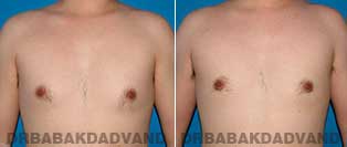 Before and After Treatment Photos - Gynecomastia Surgery - 24 year old,patient