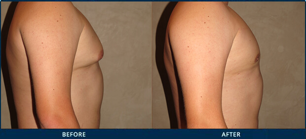 GYNECOMASTIA AND STEROID USE - Before and After Photos