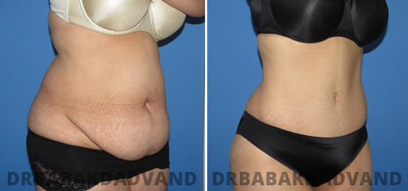 Abdominoplasty. Before and After Treatment Photos - male - front view (patient - 67)