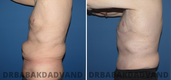 Abdominoplasty. Before and After Treatment Photos - male - front view (patient - 66)