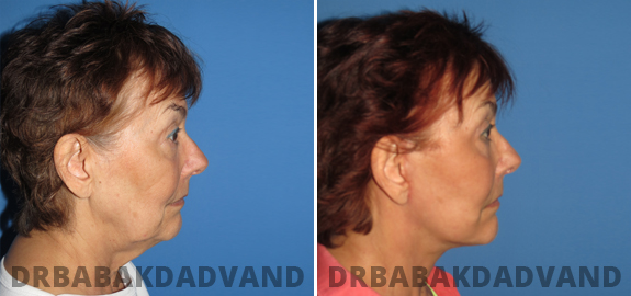 Abdominoplasty. Before and After Treatment Photos - male - front view (patient - 77)