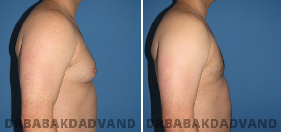 Abdominoplasty. Before and After Treatment Photos - male - front view (patient - 70)