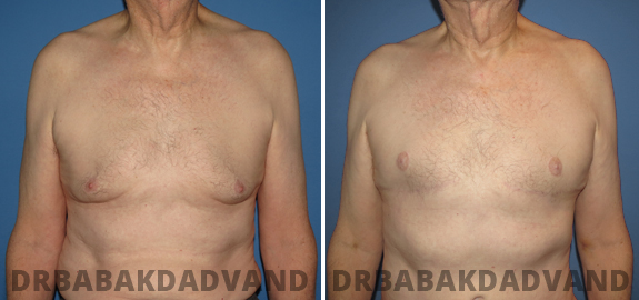 Mastopexy. Before and After Treatment Photos - male - front view (patient - 79)
