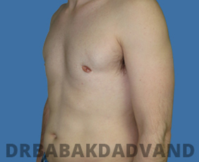 Before and After Treatment Photos: Revision Gynecomastia