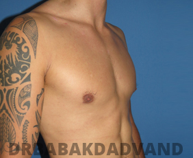 Before and After Treatment Photos: Body Builders